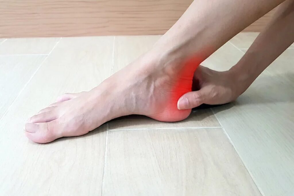 How Long Does Achilles Tendonitis Last and How to Recover